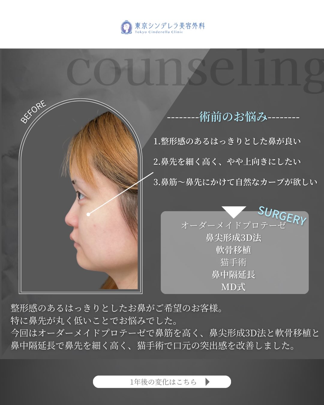 新宿院で行ったMD式の鼻尖形成3D法と軟骨移植とオーダーメイドプロテーゼと鼻中隔延長と猫手術の1年後の症例写真