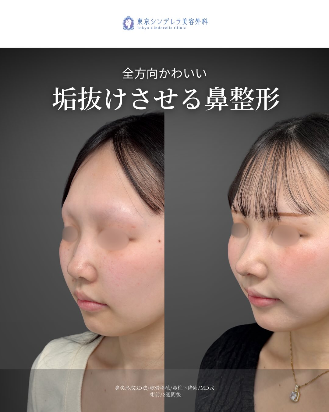 2週間で可愛く垢抜け 」に関する美容整形の症例写真の詳細 | 新宿