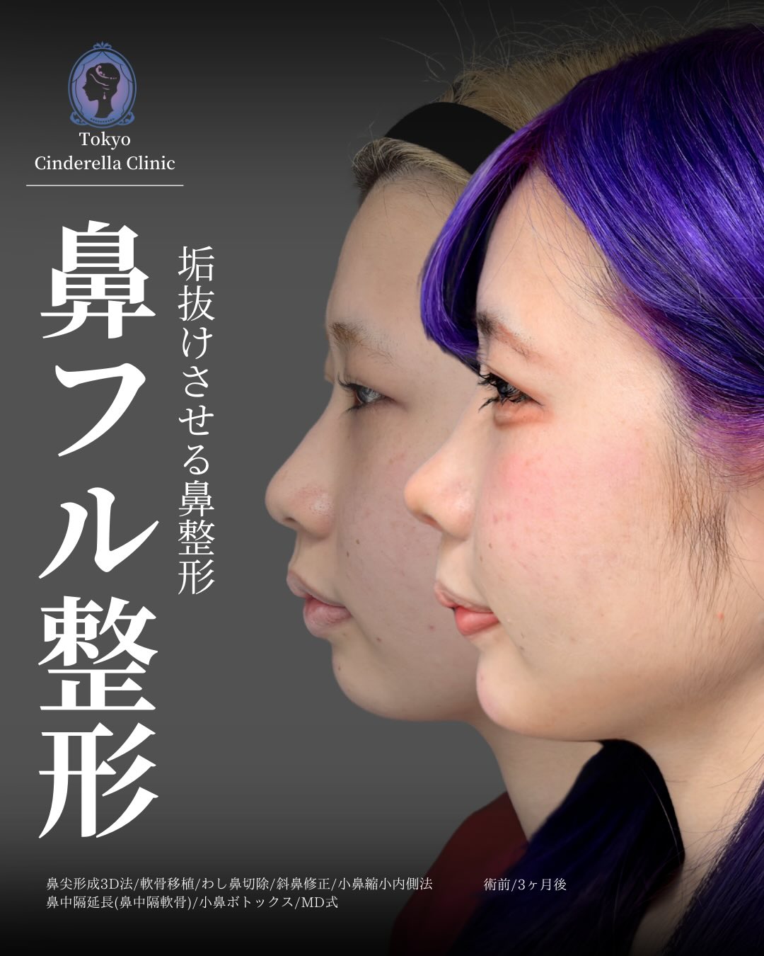 新宿院の鼻整形で有名な吉原伯医師のMD式の鼻尖形成3D法と軟骨移植と小鼻縮小内側法とわし鼻切除と斜鼻修正と小鼻ボトックスの鼻フル整形を行った3ヵ月後の症例写真