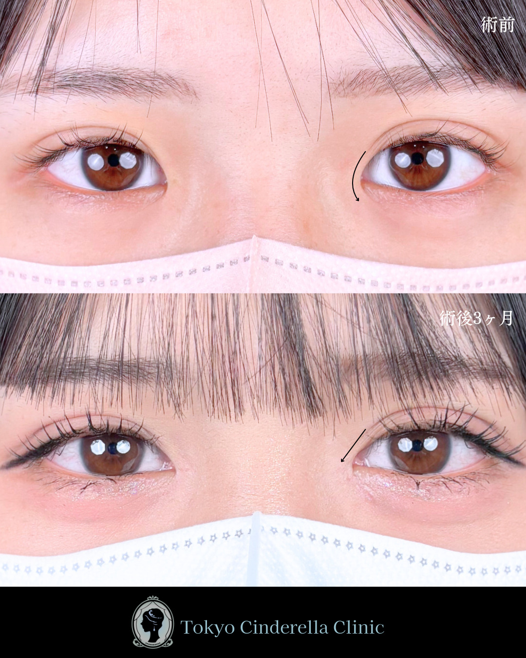 池袋院で行ったMD式目頭切開整形で有名な名医の石井達也の症例写真