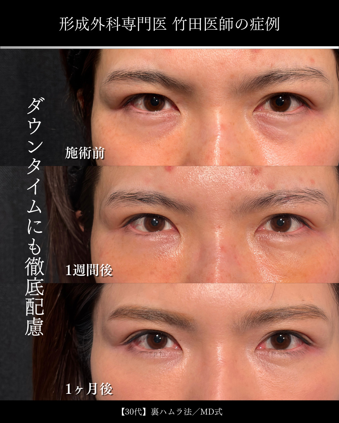 大宮院で行なった裏ハムラ法の1ヶ月の症例写真