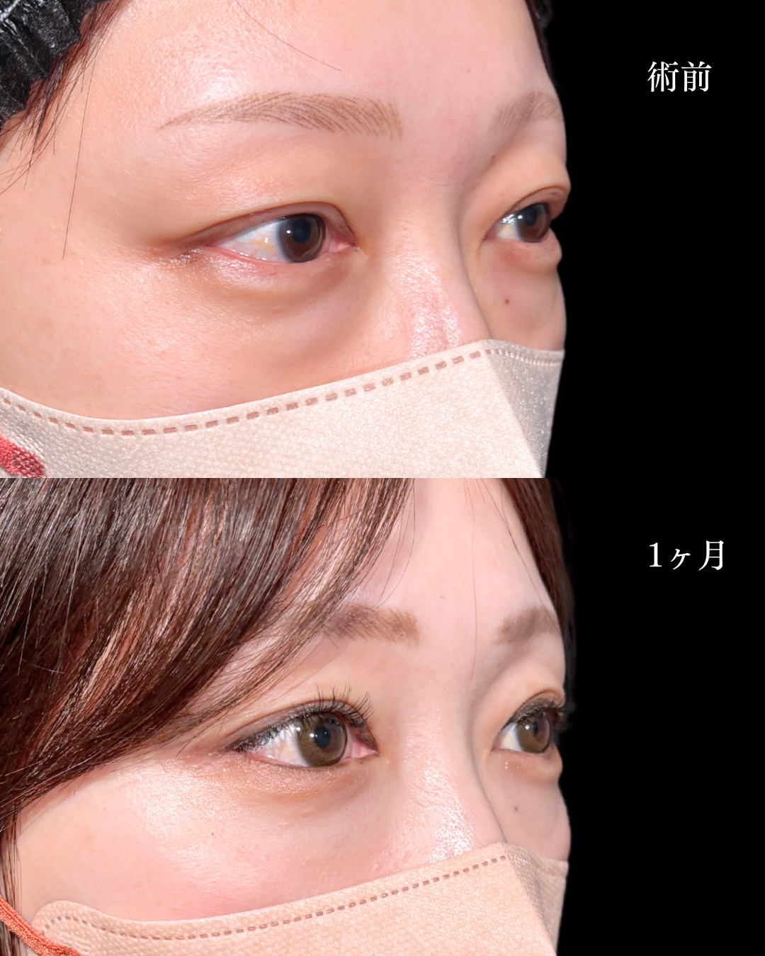 大宮院で行ったMD式の裏ハムラ法の1ヶ月後の症例写真