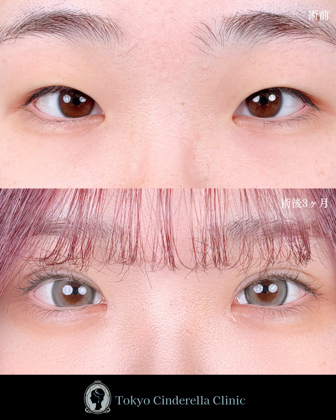 池袋院で行ったMD式目頭切開と韓国式自然癒着法6点整形で有名な名医の石井達也の症例写真