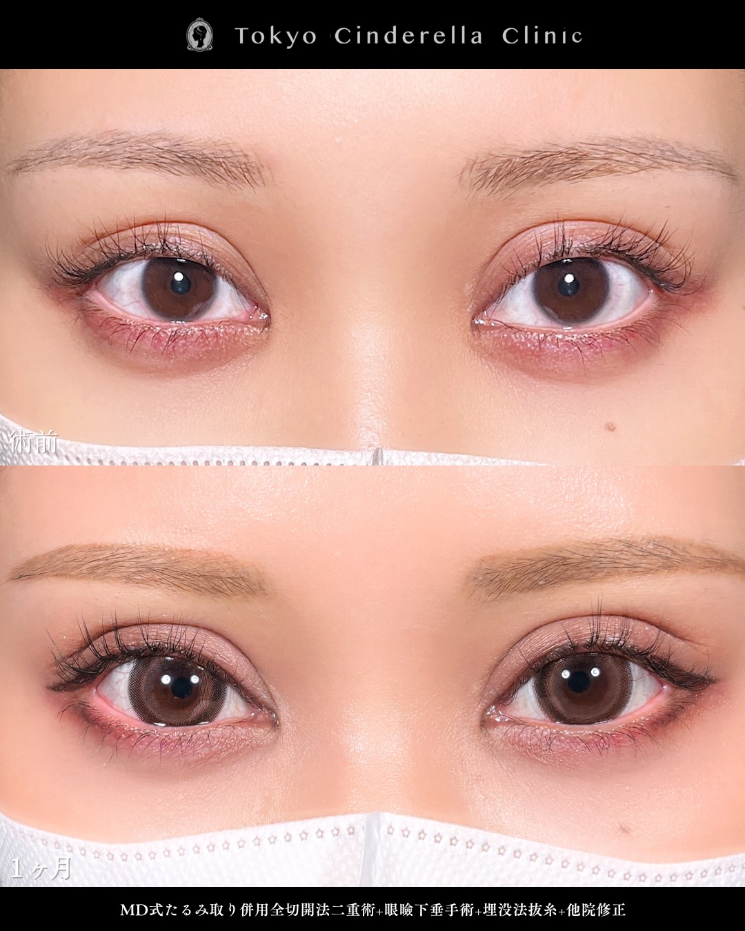 新宿院で行った二重整形で有名な吉原伯医師のMD式のたるみ取り併用全切開法二重術と眼瞼下垂手術と他院修正の1ヵ月後のダウンタイム症例写真
