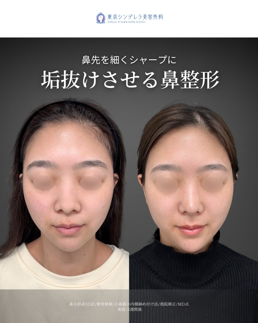 新宿院で行ったMD式の鼻尖形成3D法と軟骨移植と小鼻縮小内側締め付け法と他院修正の2週間後の症例写真