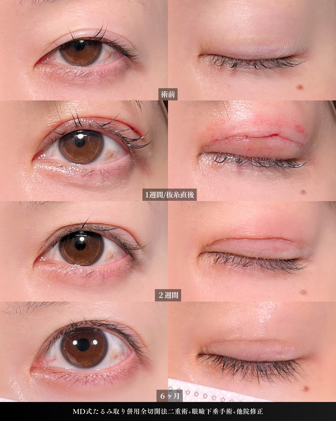 新宿院で行った二重整形で有名な吉原伯医師のMD式のたるみ取り併用全切開法二重術と眼瞼下垂手術と他院修正の6ヵ月後のダウンタイム症例写真