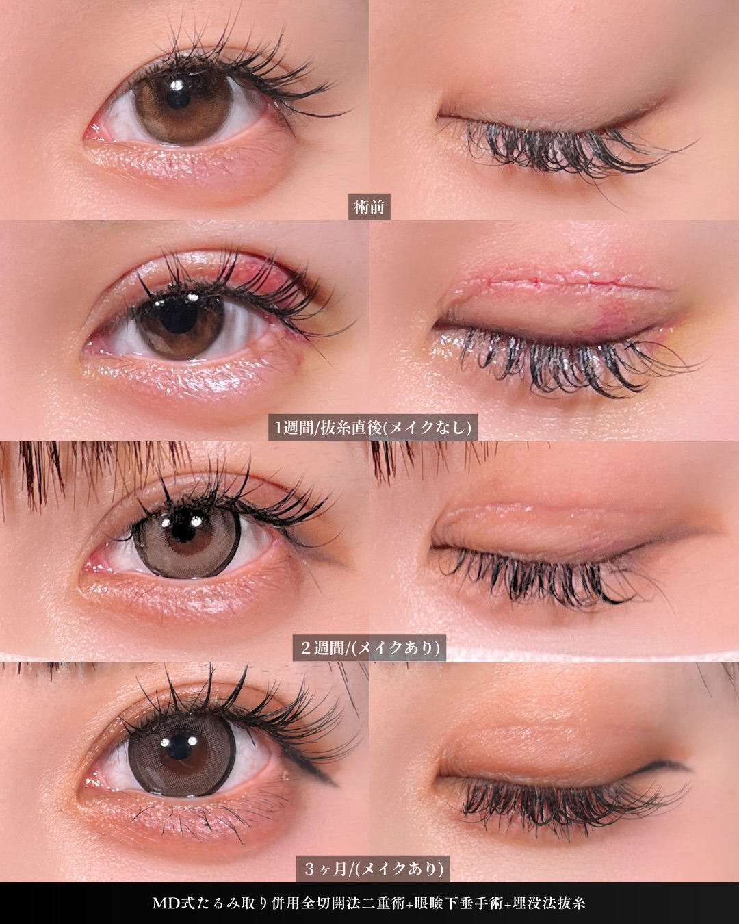 新宿院で行った二重整形で有名な吉原伯医師のMD式のたるみ取り併用全切開法二重術と眼瞼下垂手術の3ヵ月後のダウンタイム症例写真