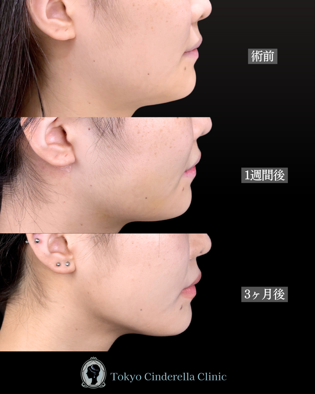 池袋院で行ったアキーセル小顔脂肪吸引(頬・あご下・エラ下・ジョールファット) とクイックリフト8本整形で有名な名医の石井達也の症例写真