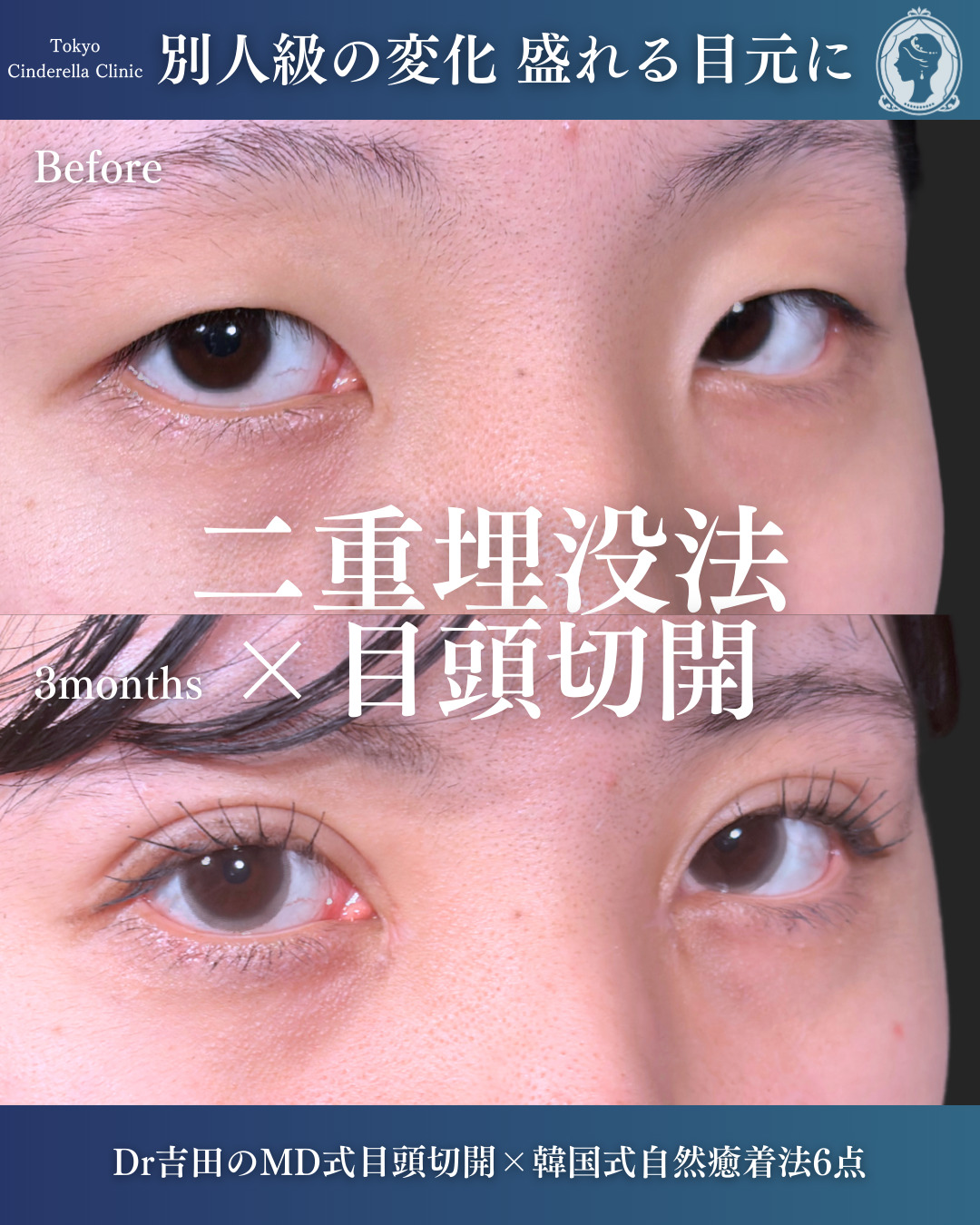 新宿院で行ったMD式目頭切開と韓国式自然癒着法6点整形で有名な名医の吉田利之の症例写真