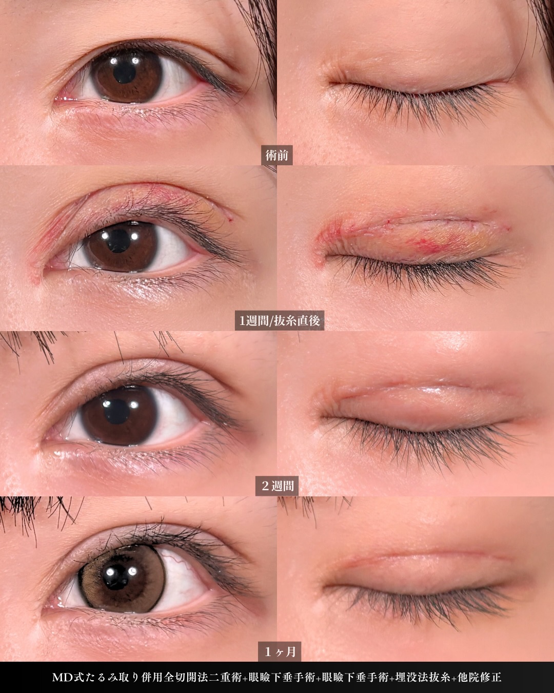新宿院で行った二重整形で有名な吉原伯医師のMD式のたるみ取り併用全切開法二重術と眼瞼下垂手術と他院修正の1週間までのダウンタイム症例写真