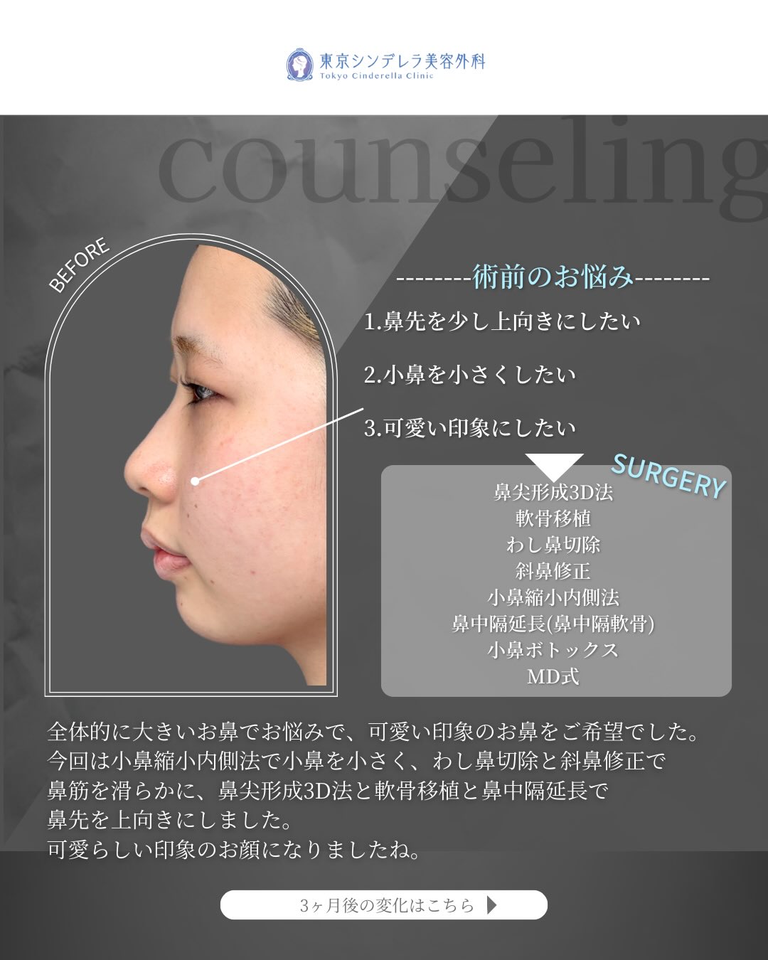 新宿院の鼻整形で有名な吉原伯医師のMD式の鼻尖形成3D法と軟骨移植と小鼻縮小内側法とわし鼻切除と斜鼻修正と小鼻ボトックスの鼻フル整形を行った3ヵ月後の症例写真