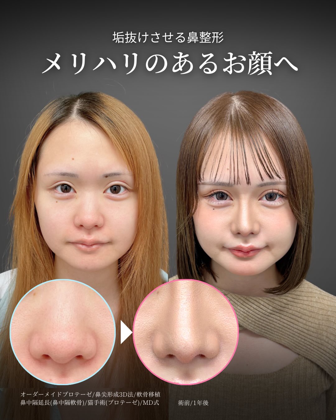 新宿院で行ったMD式の鼻尖形成3D法と軟骨移植とオーダーメイドプロテーゼと鼻中隔延長と猫手術の1年後の症例写真