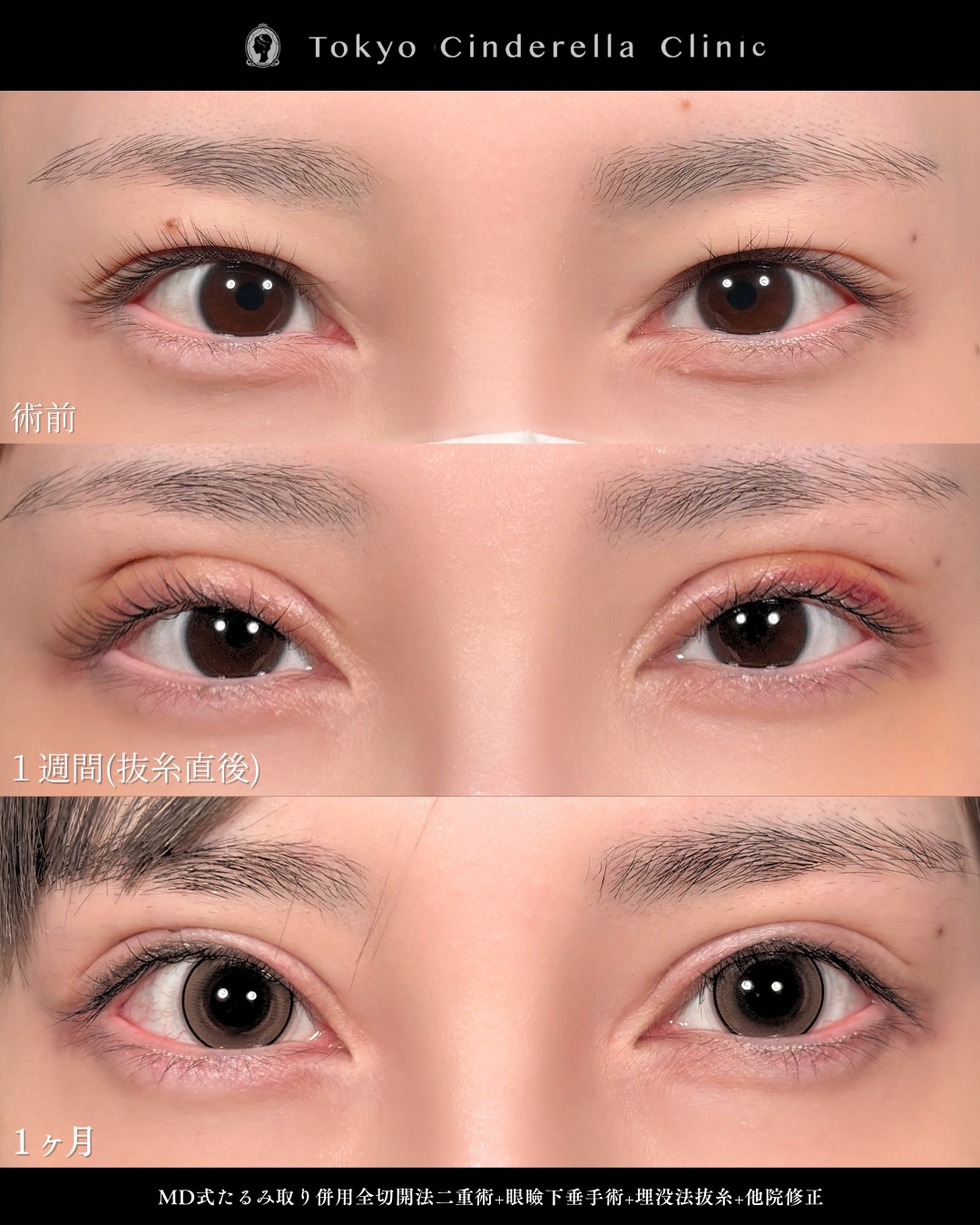 新宿院で行った二重整形で有名な吉原伯医師のMD式のたるみ取り併用全切開法二重術と眼瞼下垂手術と他院修正の1ヵ月までのダウンタイム症例写真