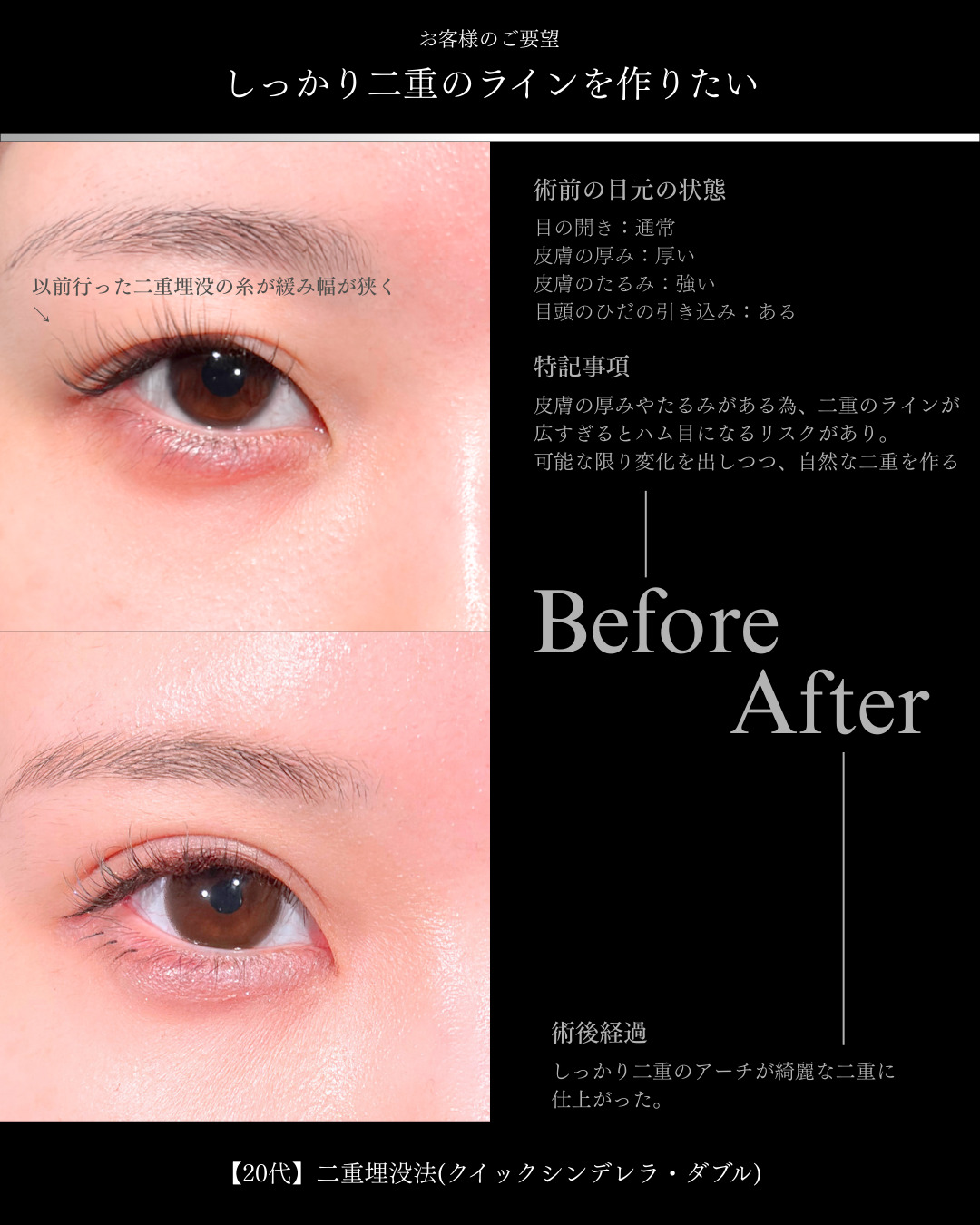 大宮院で行った二重埋没法の1ヶ月後の症例写真