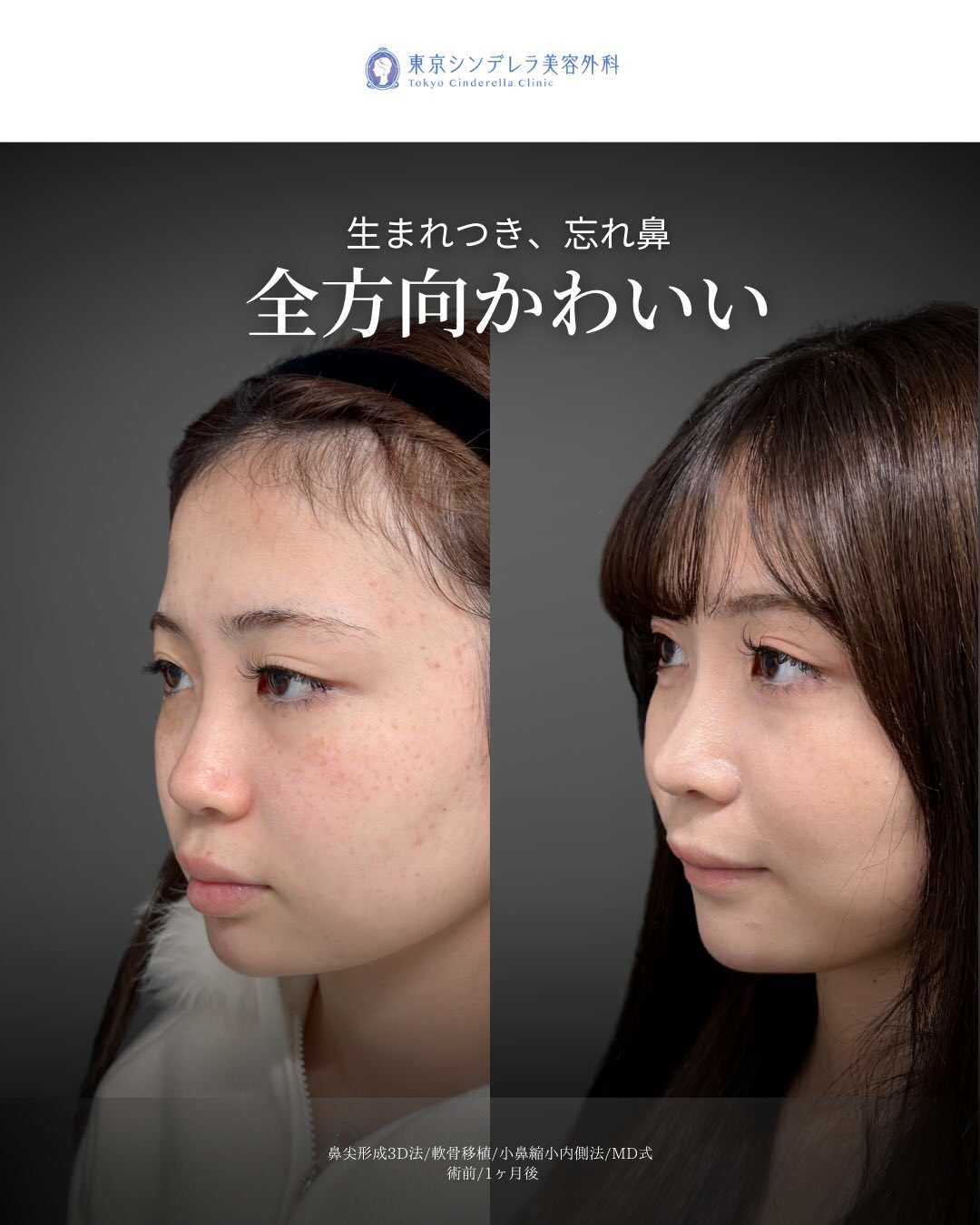 新宿院で行ったMD式の鼻尖形成3D法と軟骨移植と小鼻縮小内側法の1ヵ月後の症例写真