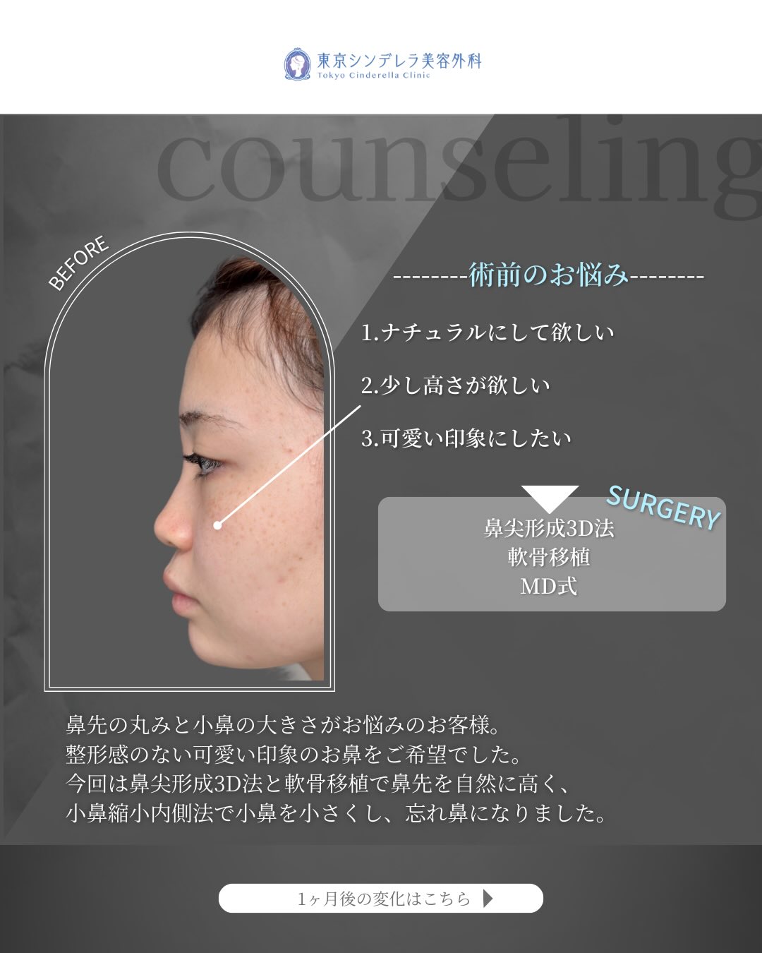 新宿院で行ったMD式の鼻尖形成3D法と軟骨移植と小鼻縮小内側法の1ヵ月後の症例写真