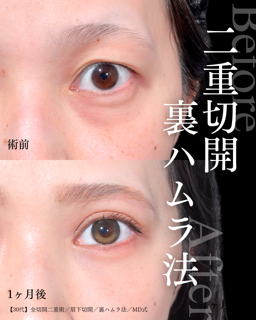 大宮院で行なった全切開二重術と眉下切開と裏ハムラ法の症例写真