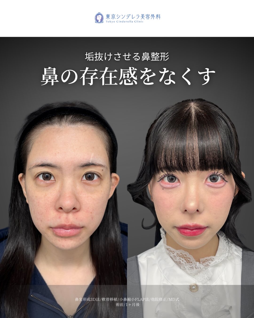 垢抜けさせる鼻整形 」に関する美容整形の症例写真の詳細 | 新宿・池袋