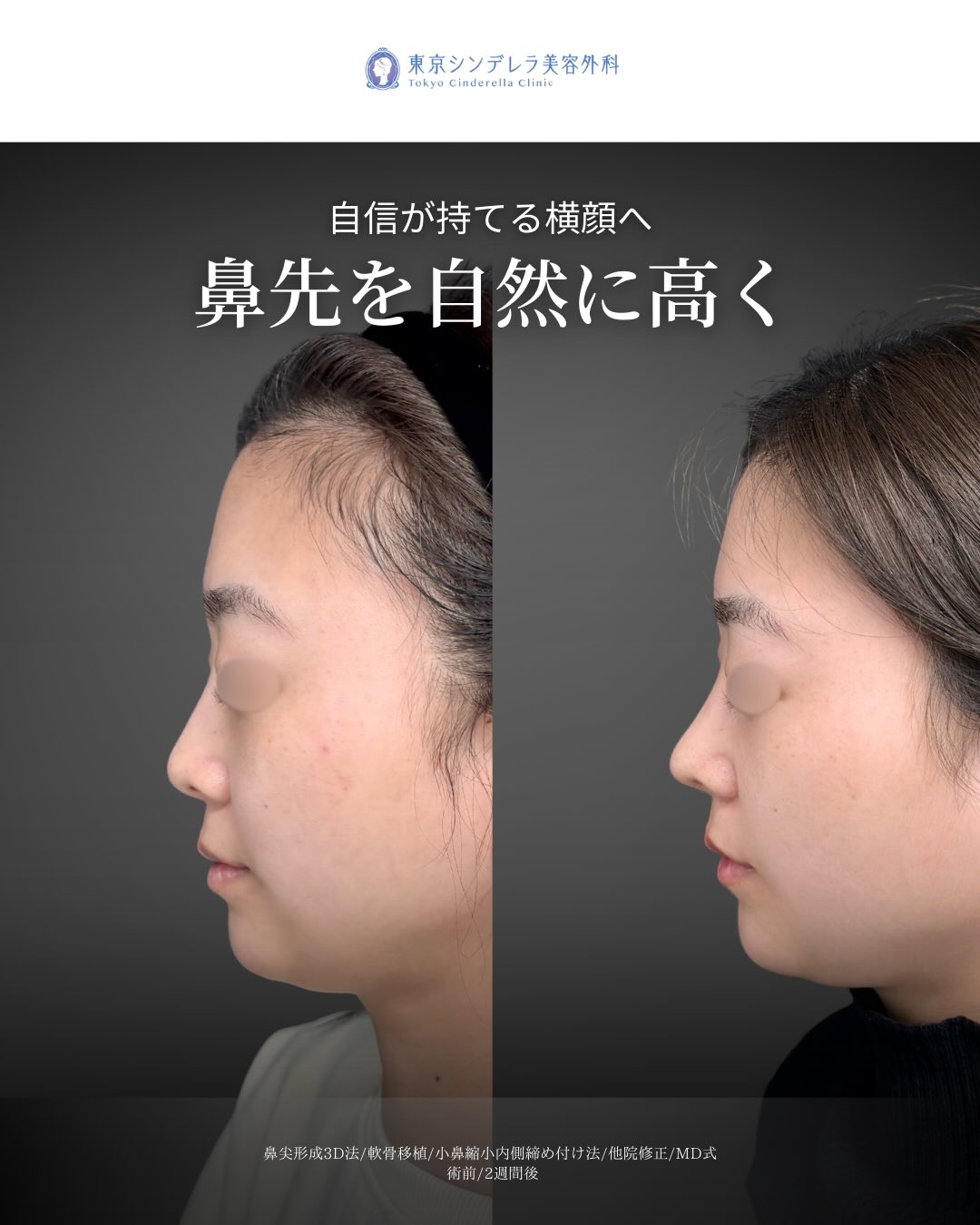 新宿院で行ったMD式の鼻尖形成3D法と軟骨移植と小鼻縮小内側締め付け法と他院修正の2週間後の症例写真