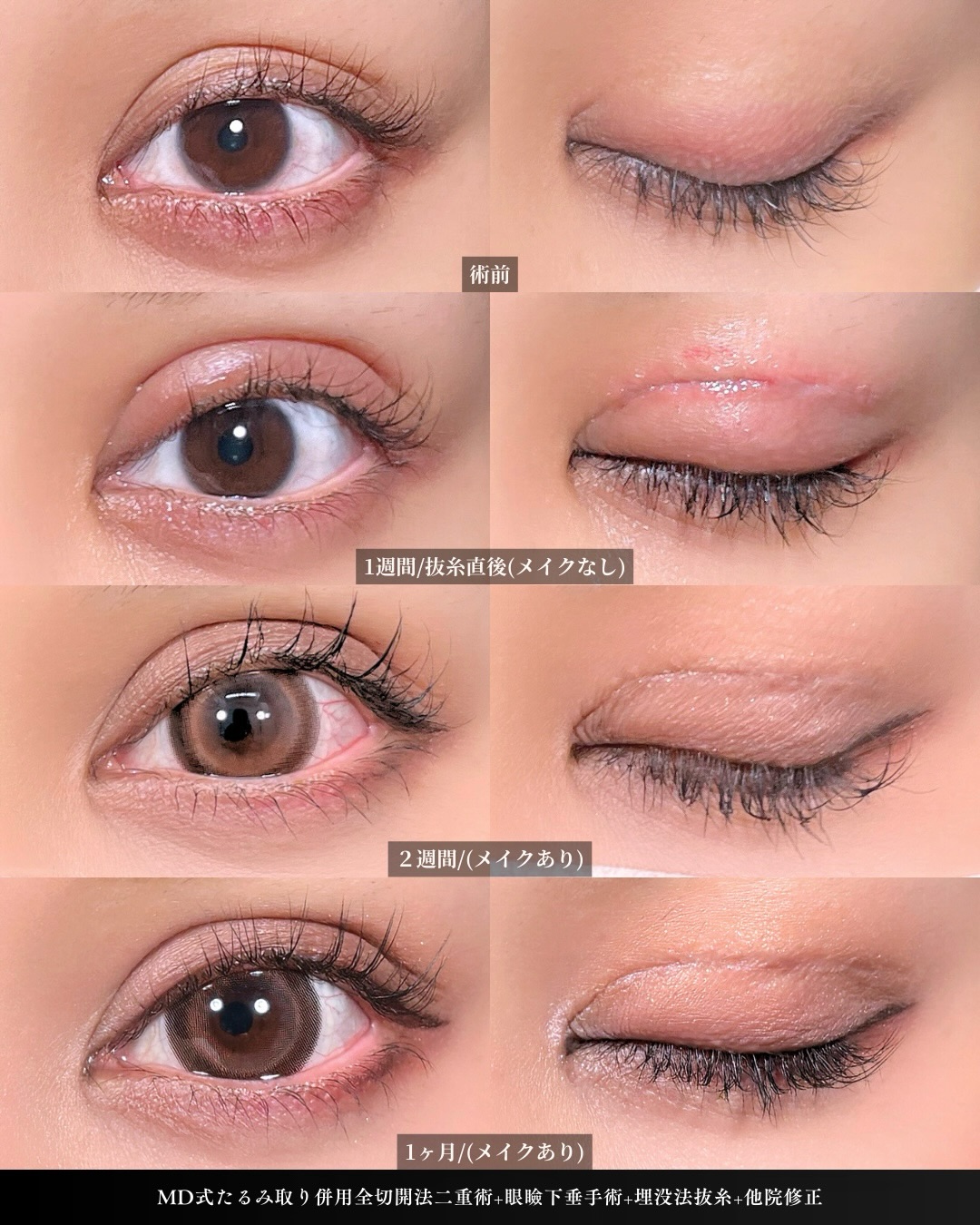 新宿院で行った二重整形で有名な吉原伯医師のMD式のたるみ取り併用全切開法二重術と眼瞼下垂手術と他院修正の1ヵ月後のダウンタイム症例写真