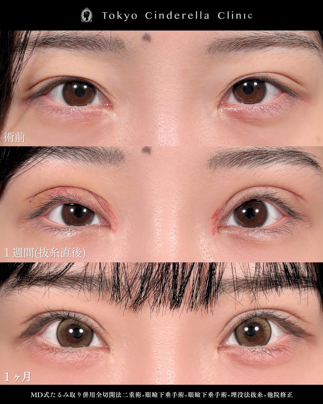 新宿院で行った二重整形で有名な吉原伯医師のMD式のたるみ取り併用全切開法二重術と眼瞼下垂手術と他院修正の1週間までのダウンタイム症例写真
