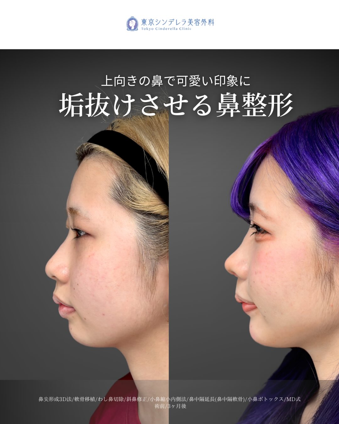 新宿院の鼻整形で有名な吉原伯医師のMD式の鼻尖形成3D法と軟骨移植と小鼻縮小内側法とわし鼻切除と斜鼻修正と小鼻ボトックスの鼻フル整形を行った3ヵ月後の症例写真