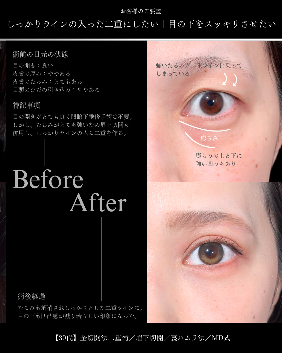 大宮院で行なった全切開二重術と眉下切開と裏ハムラ法の症例写真