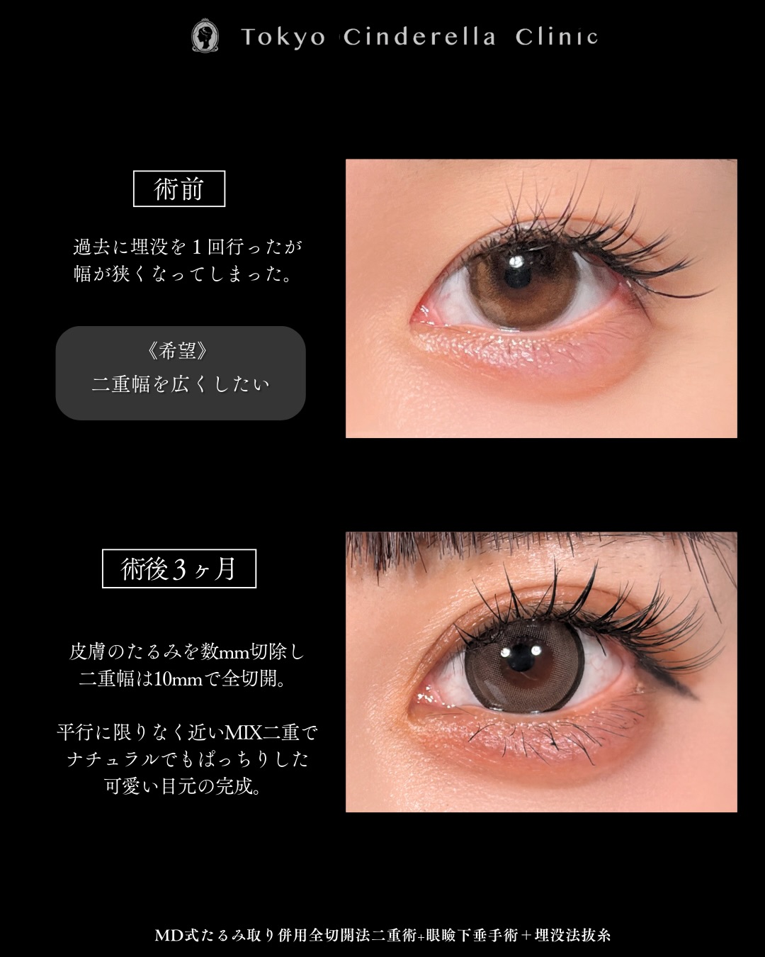 新宿院で行った二重整形で有名な吉原伯医師のMD式のたるみ取り併用全切開法二重術と眼瞼下垂手術の3ヵ月後のダウンタイム症例写真