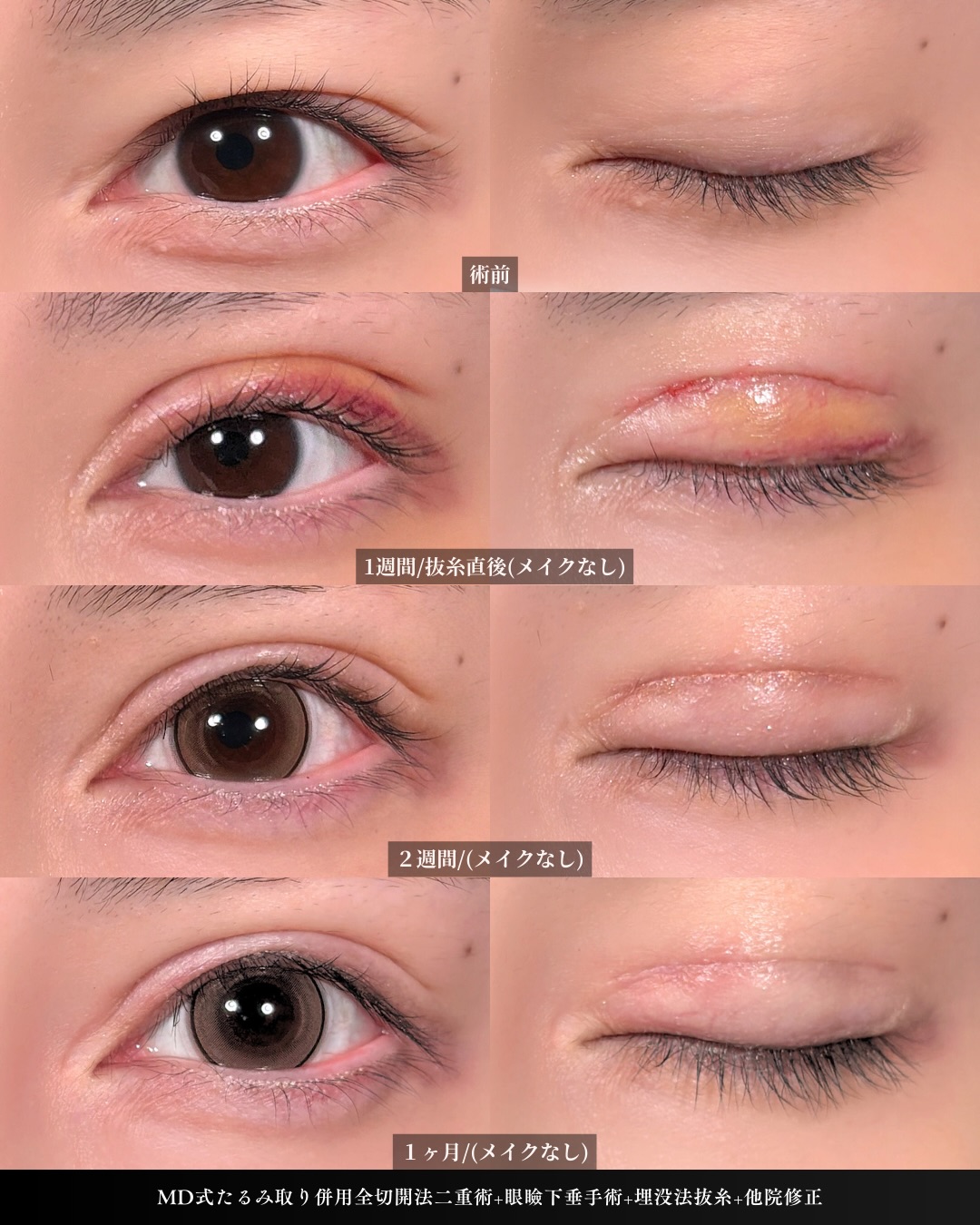 新宿院で行った二重整形で有名な吉原伯医師のMD式のたるみ取り併用全切開法二重術と眼瞼下垂手術と他院修正の1ヵ月までのダウンタイム症例写真
