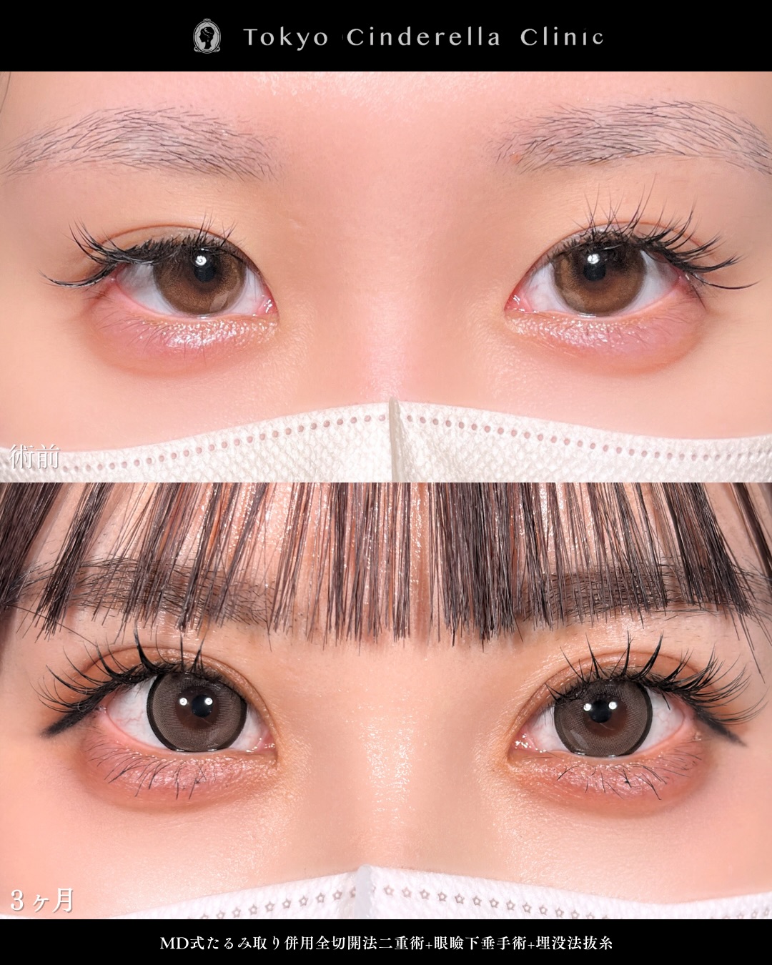 新宿院で行った二重整形で有名な吉原伯医師のMD式のたるみ取り併用全切開法二重術と眼瞼下垂手術の3ヵ月後のダウンタイム症例写真