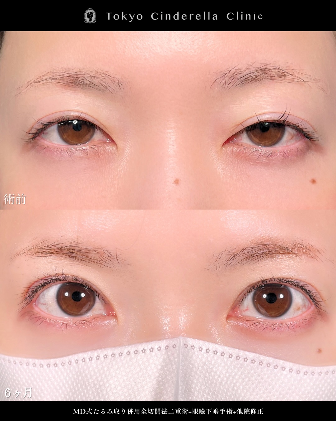 新宿院で行った二重整形で有名な吉原伯医師のMD式のたるみ取り併用全切開法二重術と眼瞼下垂手術と他院修正の6ヵ月後のダウンタイム症例写真