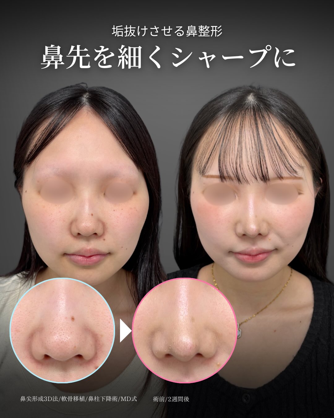 鼻柱下降術でACRを整える 」に関する美容整形の症例写真の詳細 | 新宿