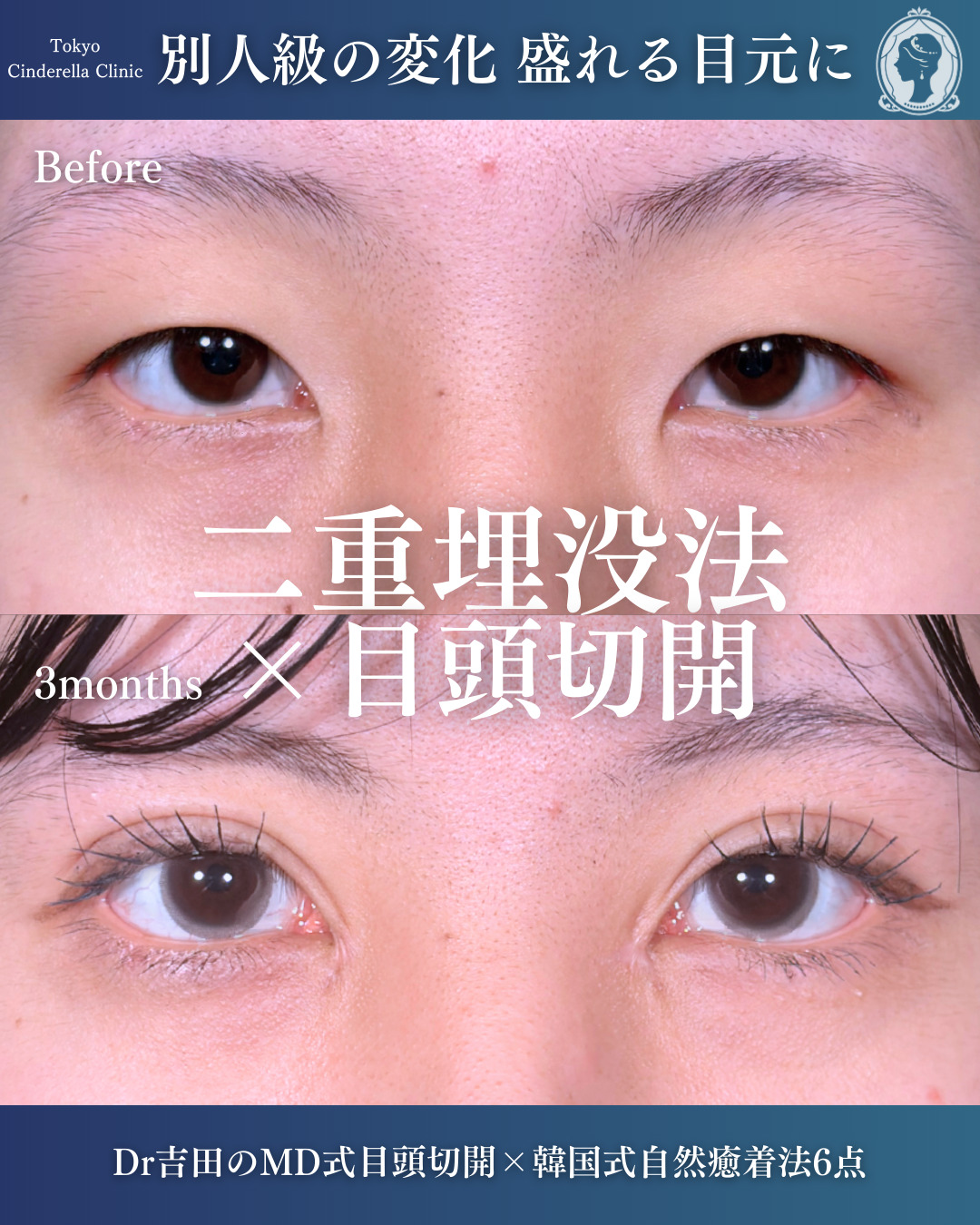 新宿院で行ったMD式目頭切開と韓国式自然癒着法6点整形で有名な名医の吉田利之の症例写真
