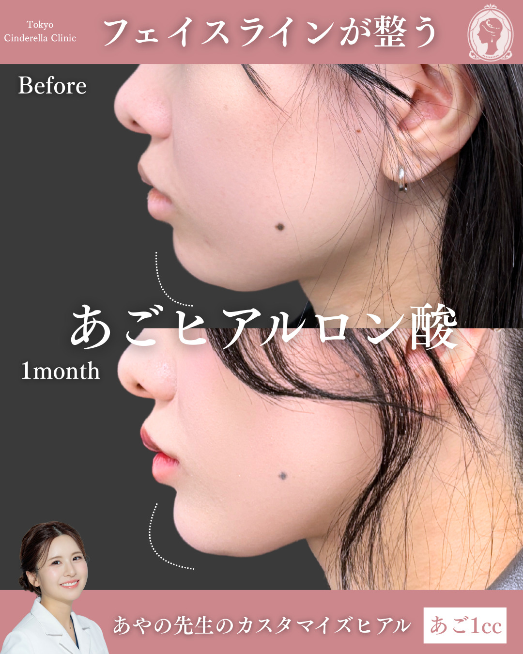 顎ヒアルロン酸で横顔美人に 」に関する美容整形の症例写真の詳細