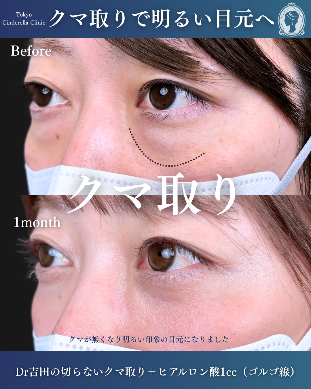 新宿院で行ったクマ治療の名医の吉田利之医師の症例写真