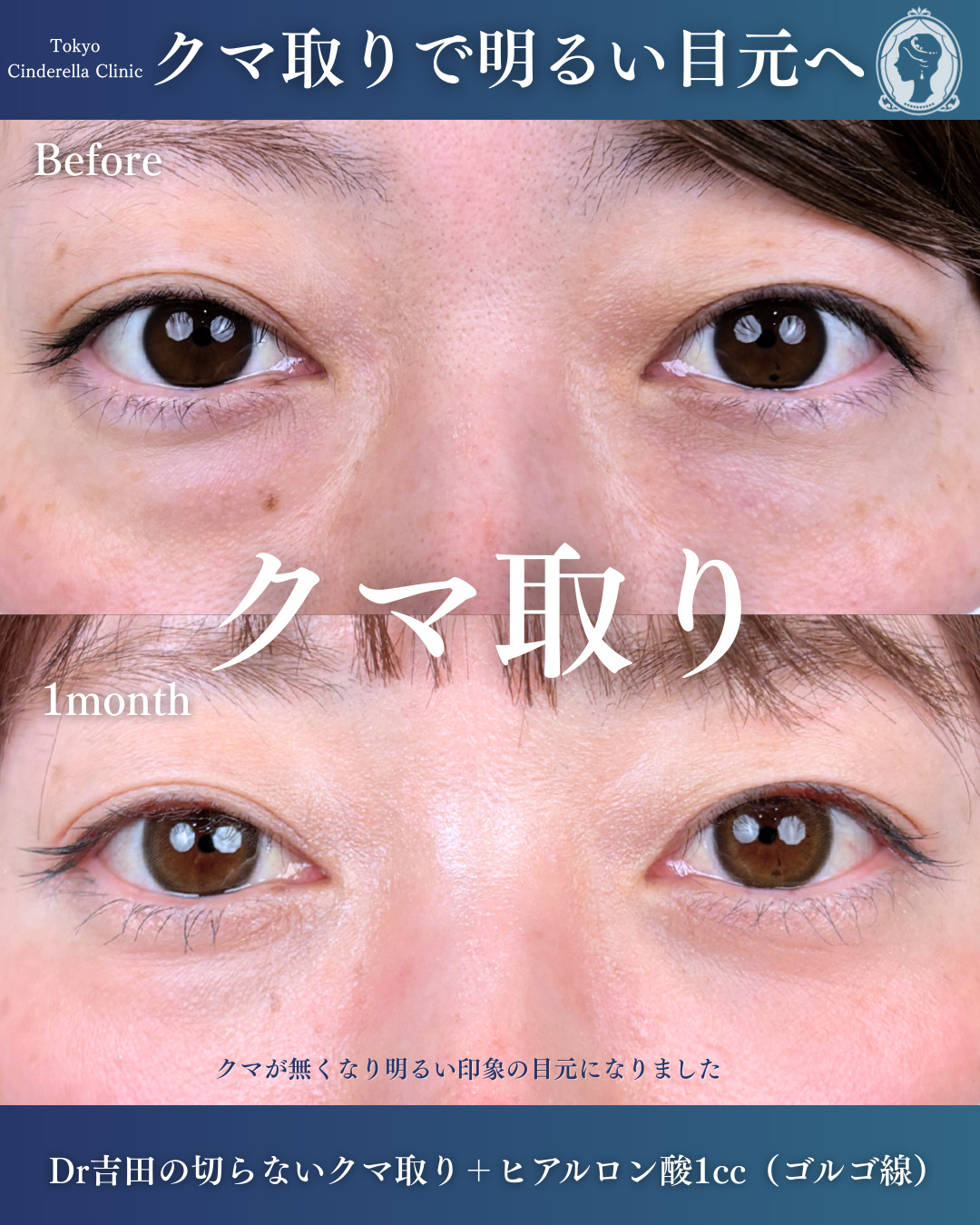 新宿院で行ったクマ治療の名医の吉田利之医師の症例写真