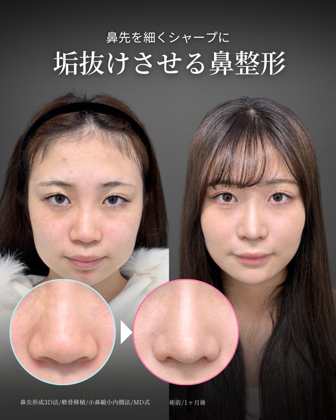 新宿院で行ったMD式の鼻尖形成3D法と軟骨移植と小鼻縮小内側法の1ヵ月後の症例写真