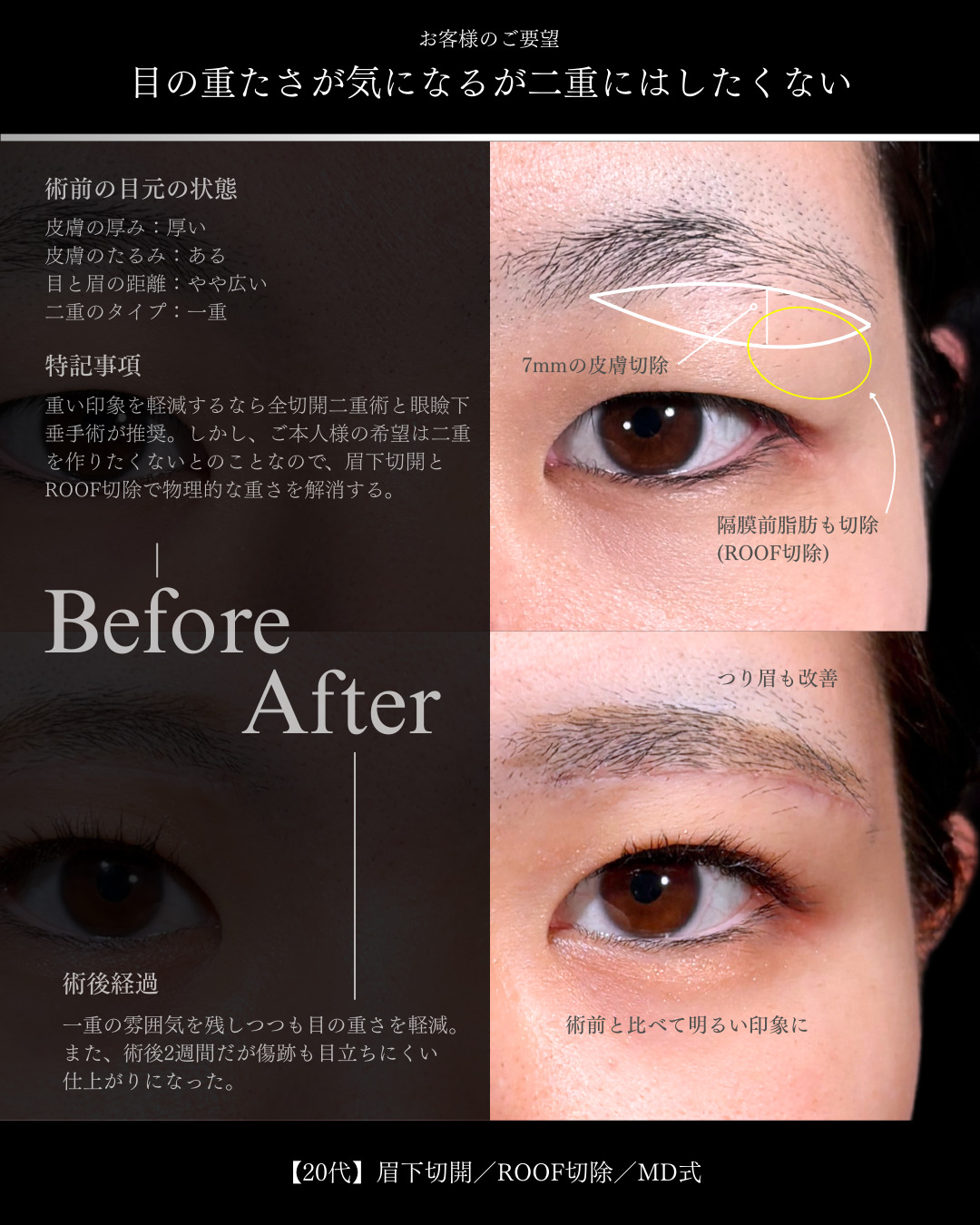 大宮院で行った眉下切開の2週間後の症例写真