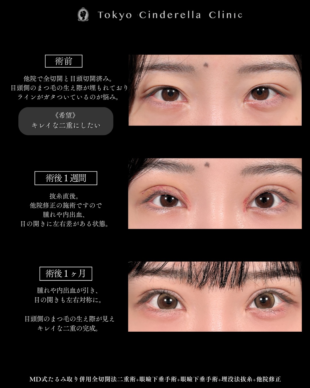 新宿院で行った二重整形で有名な吉原伯医師のMD式のたるみ取り併用全切開法二重術と眼瞼下垂手術と他院修正の1週間までのダウンタイム症例写真