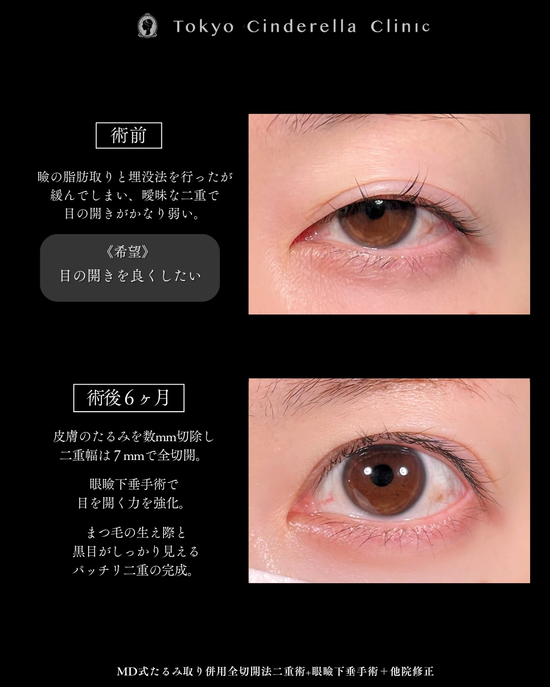 新宿院で行った二重整形で有名な吉原伯医師のMD式のたるみ取り併用全切開法二重術と眼瞼下垂手術と他院修正の6ヵ月後までのダウンタイム症例写真