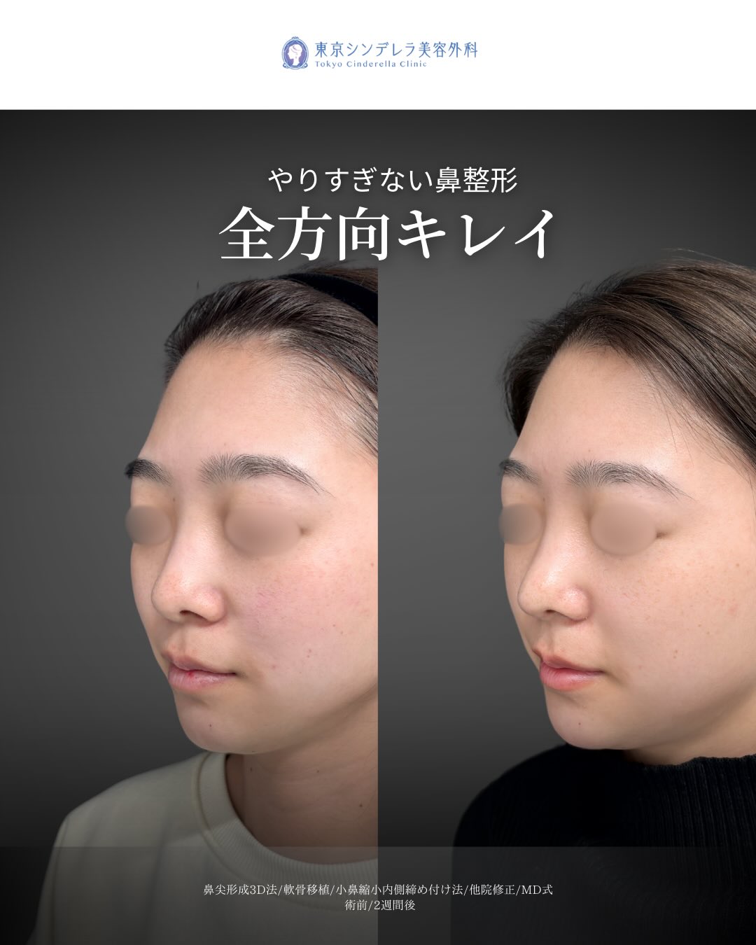 新宿院で行ったMD式の鼻尖形成3D法と軟骨移植と小鼻縮小内側締め付け法と他院修正の2週間後の症例写真