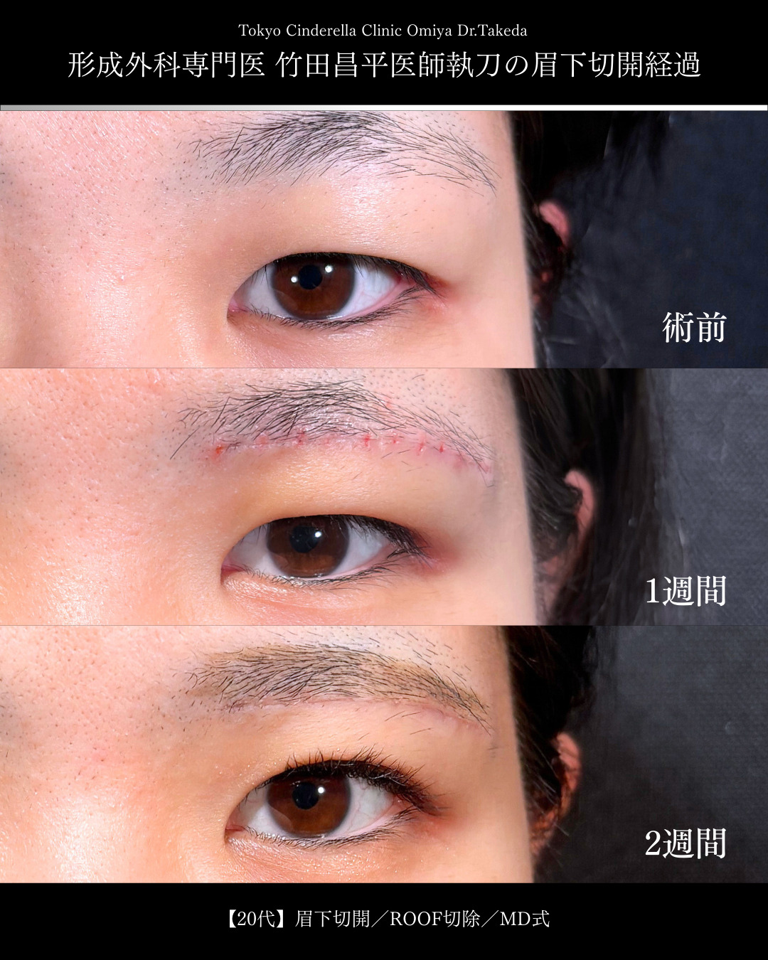 大宮院で行った眉下切開の2週間後の症例写真