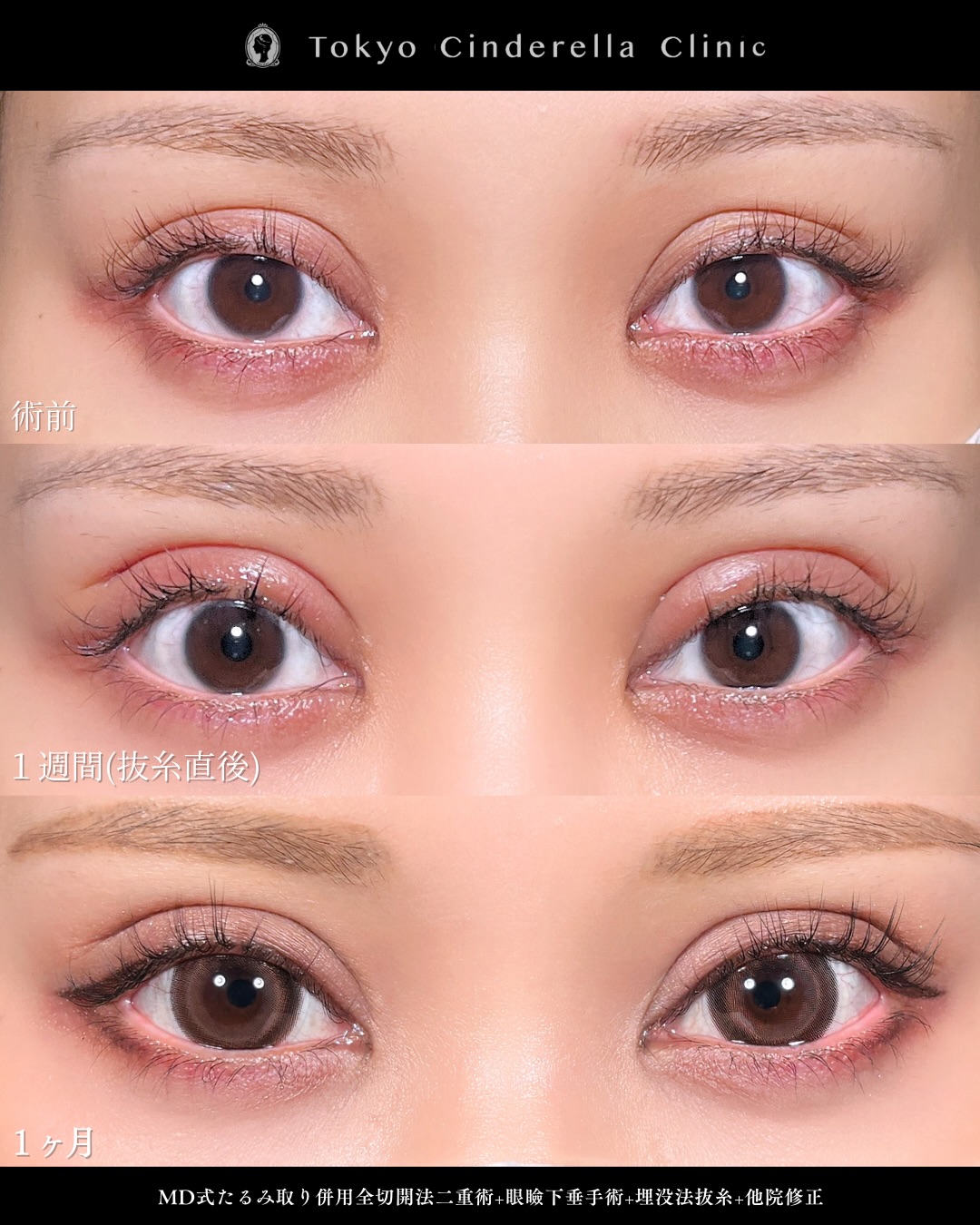 新宿院で行った二重整形で有名な吉原伯医師のMD式のたるみ取り併用全切開法二重術と眼瞼下垂手術と他院修正の1ヵ月後のダウンタイム症例写真