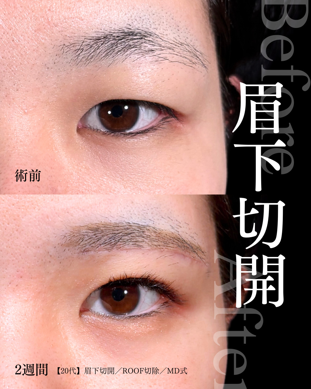 大宮院で行った眉下切開の2週間後の症例写真