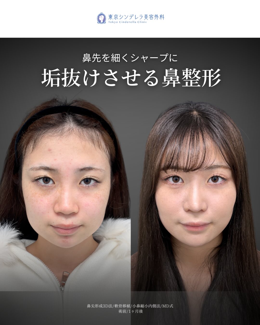 新宿院で行ったMD式の鼻尖形成3D法と軟骨移植と小鼻縮小内側法の1ヵ月後の症例写真