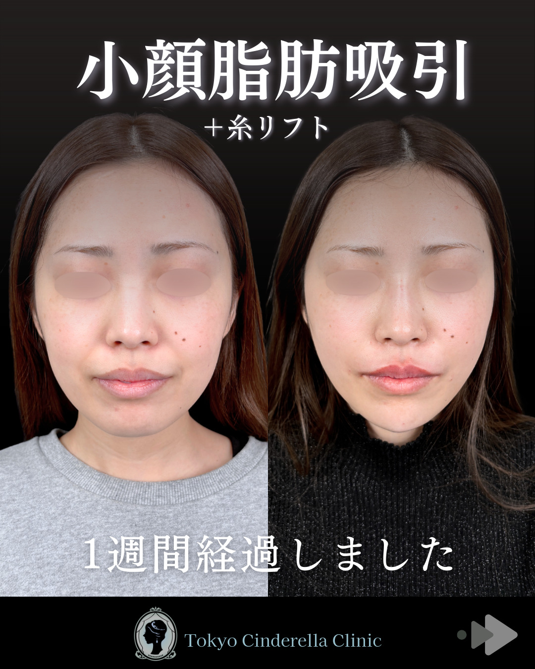 小顔脂肪吸引】1週間経過しました 」に関する美容整形の症例写真の詳細