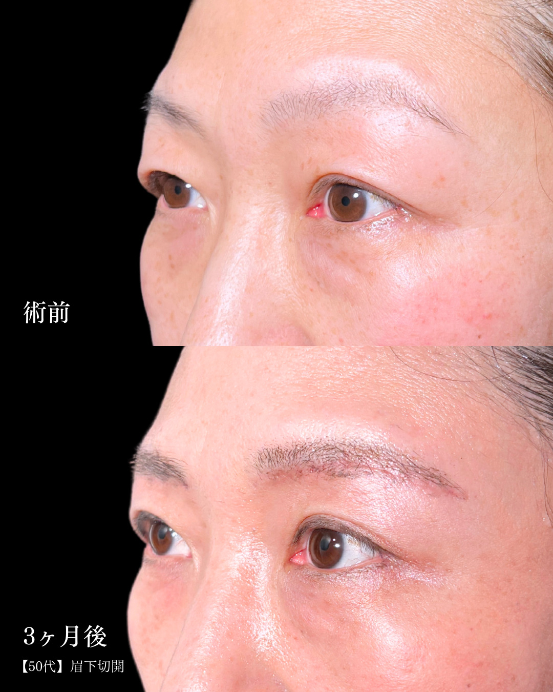 二重幅8mm 」に関する美容整形の症例写真の詳細 | 新宿・池袋・大宮