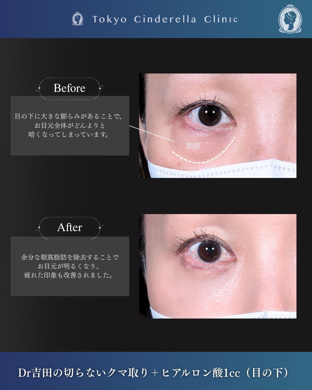 新宿院で行なった吉田利之医師の切らないクマ取りと目の下のヒアルロン酸注入の1ヵ月後の症例写真