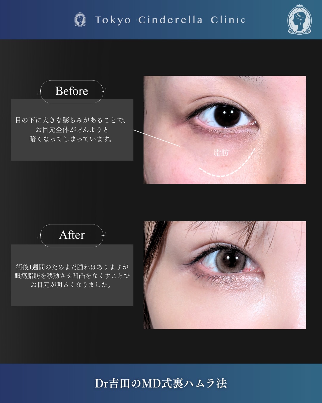 新宿院で行なったクマ取りで有名な吉田利之医師のMD式裏ハムラ法の1週間後の症例写真