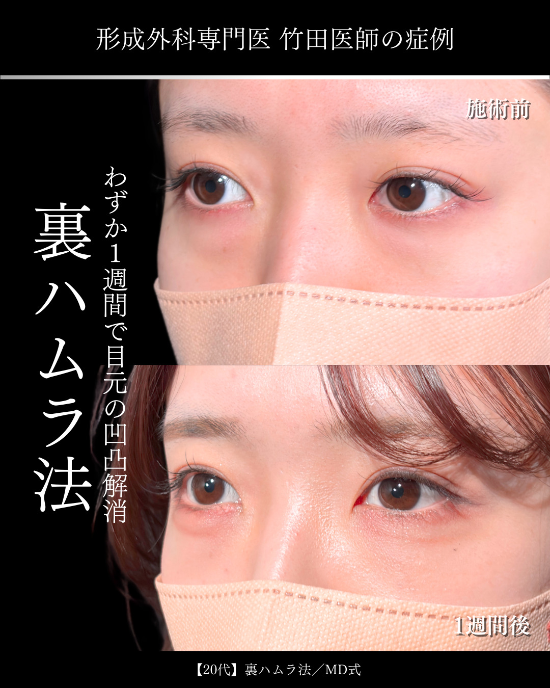 大宮院で行なった竹田昌平医師の裏ハムラ法の例写真